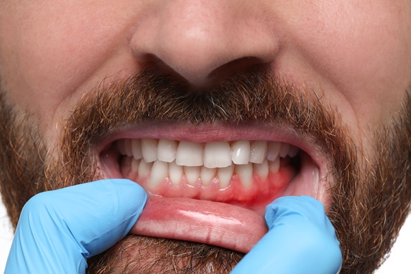 How A Dentist Can Help With Sensitive, Bleeding Gums
