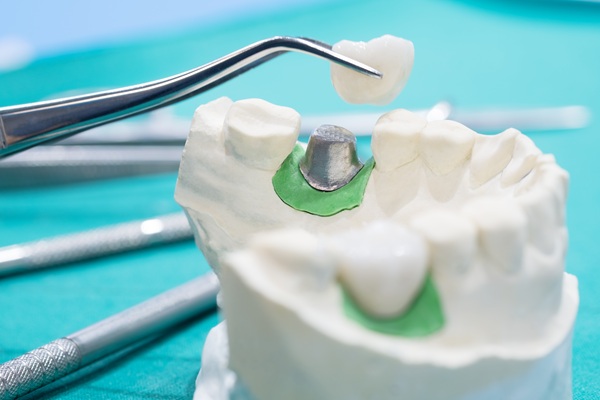 How Natural Does An Implant Crown Look?